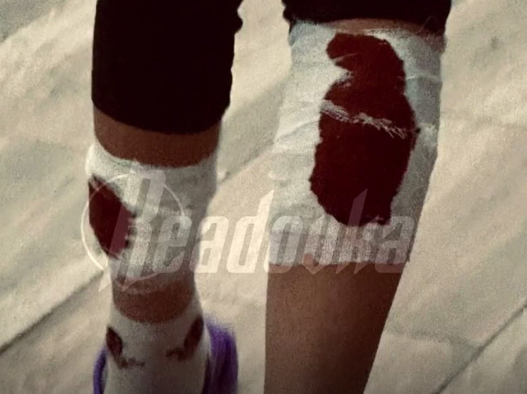 In the Ivanovo region, relatives themselves had to take a girl torn by dogs to the hospital through the whole city