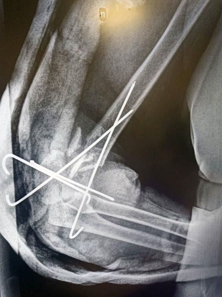 Подмосковные врачи провели сразу 4 операции женщине после ДТП