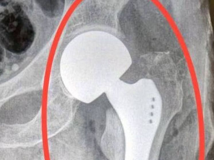 В Подмосковье врачи спасли бабушку 92 лет, которую сбил автомобиль