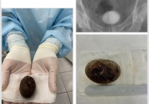 В городе Салават, что в республике Башкортостан, хирурги сохранили здоровье мужчине, у которого в мочевом пузыре был обнаружен камень размером с куриное яйцо