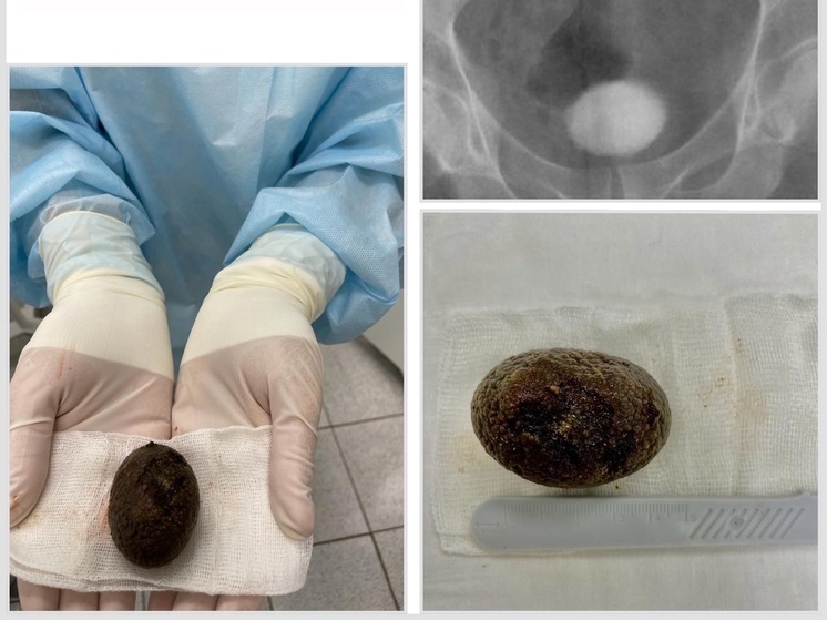 Россиянин вырастил в себе камень размером с куриное яйцо