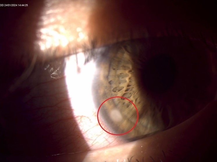 Уснувшему в контактных линзах мужчине в Чувашии спасли зрение