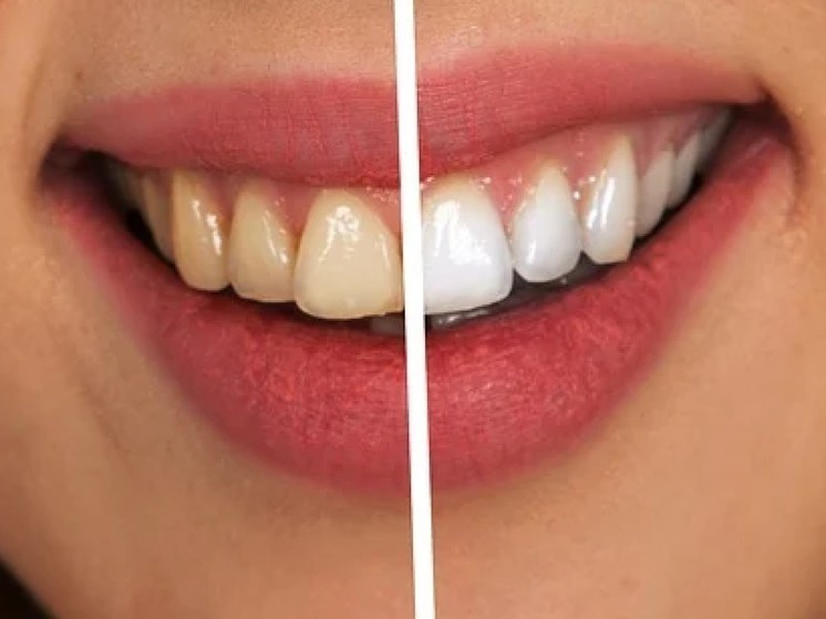 Российские ученые разработали способ предотвращения развития кариеса