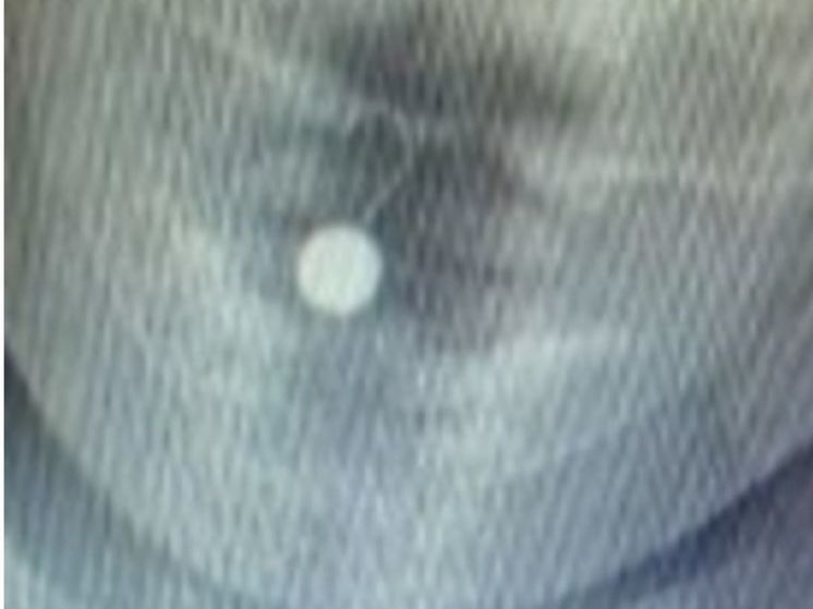 Врачи спасли 10-месячную девочку, проглотившую рыболовный крючок