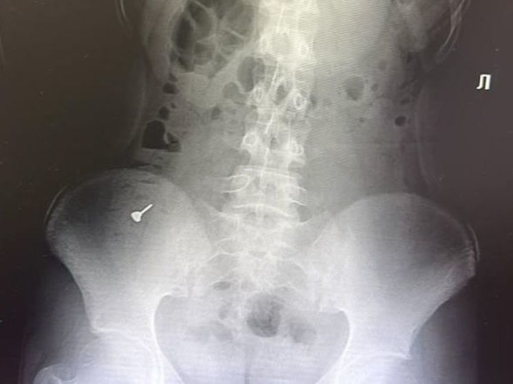 Раменские хирурги достали из живота девушки деталь от пирсинга