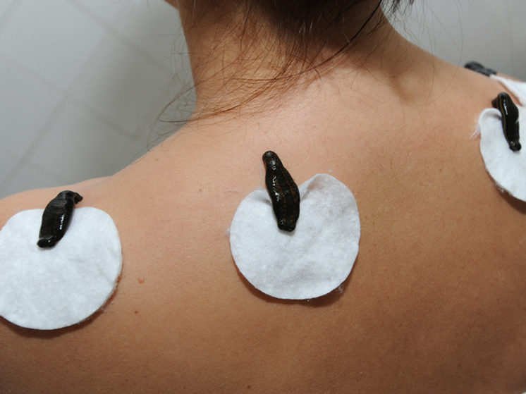 Победитель в числе прочего практикует подкожные уколы алоэ