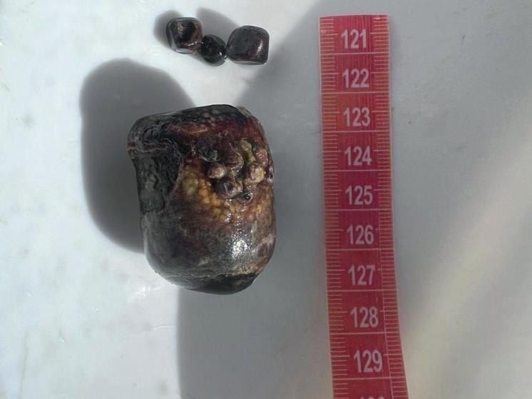 Хирурги из Пятигорска извлекли из тонкого кишечника пациентки камень аномального размера