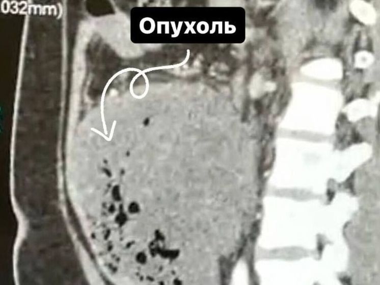 У студента обнаружили опухоль размером 15 см