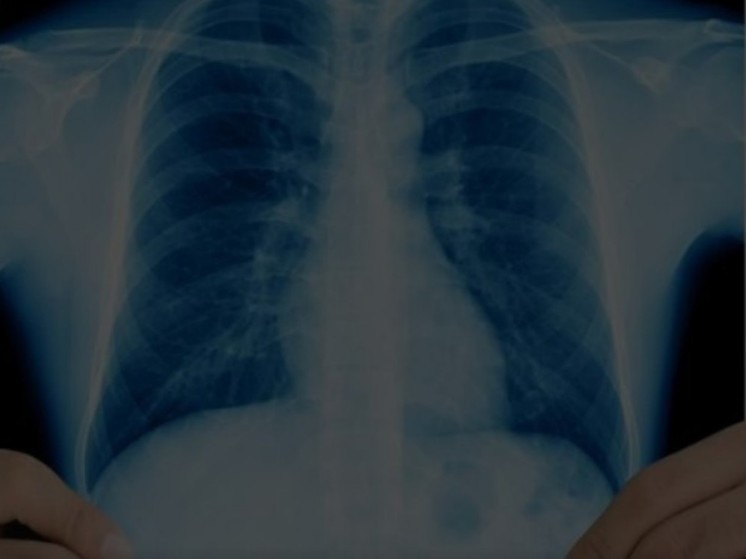 Бесплатно сделать флюорографию могут псковичи в рамках Дня борьбы с туберкулезом, 25 и 26 марта