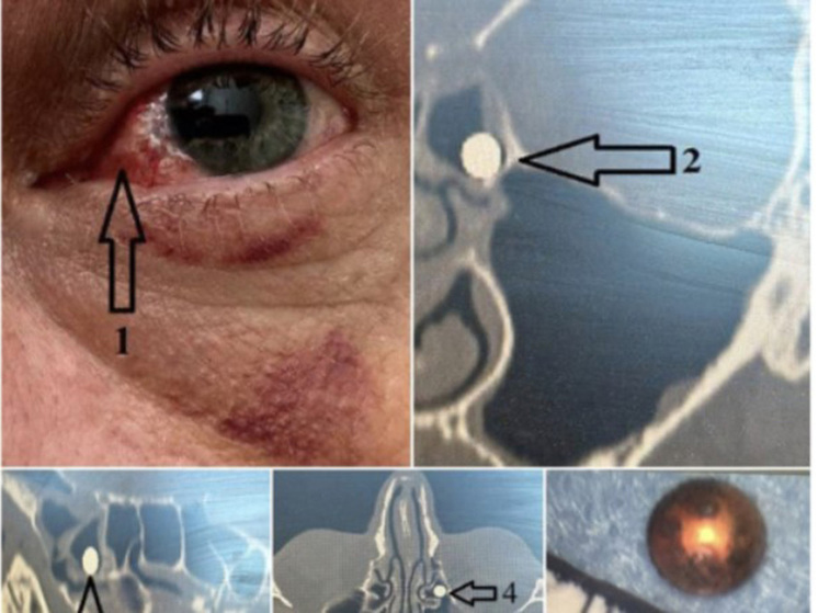 Воронежские врачи извлекли у пациента пулю, попавшую в нос через глаз