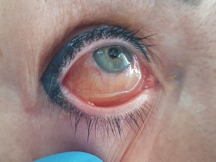 Стало известно почему воспалился глаз у женщины из Чувашии после тату-макияжа