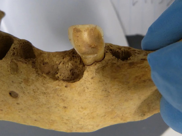Доисторические зубы помогли понять причину современного распространения кариеса