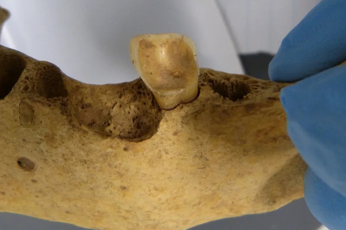Prehistoric teeth help us understand the reason for the modern spread of dental caries