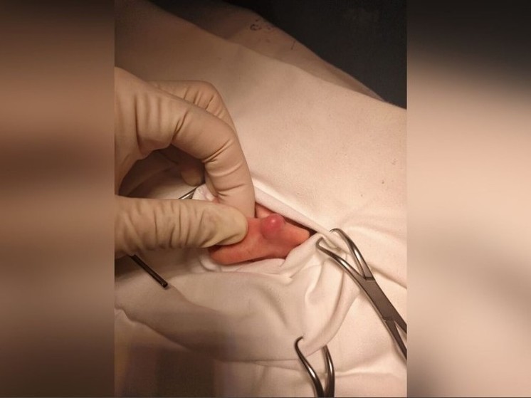 Воронежские медики прооперировали ребенка с редкой патологией ушной раковины
