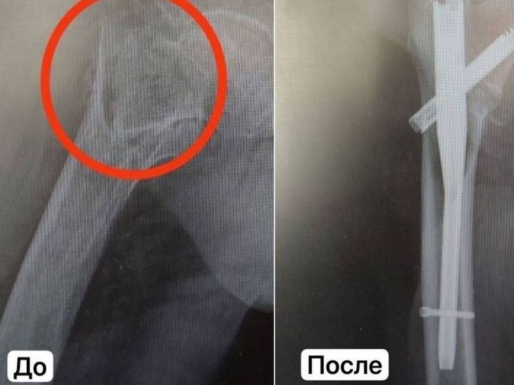 Каширские врачи спасли долгожительницу с переломом бедра