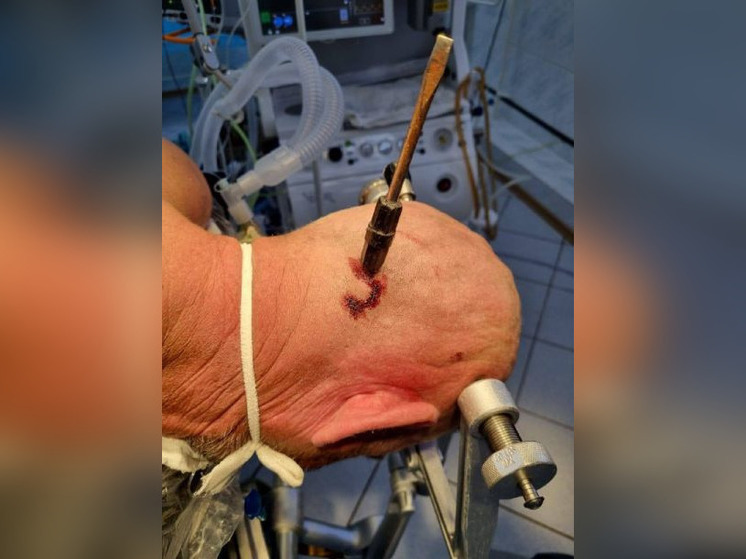 Башкирские хирурги спасли 44-летнего пациента с отверткой в черепе
