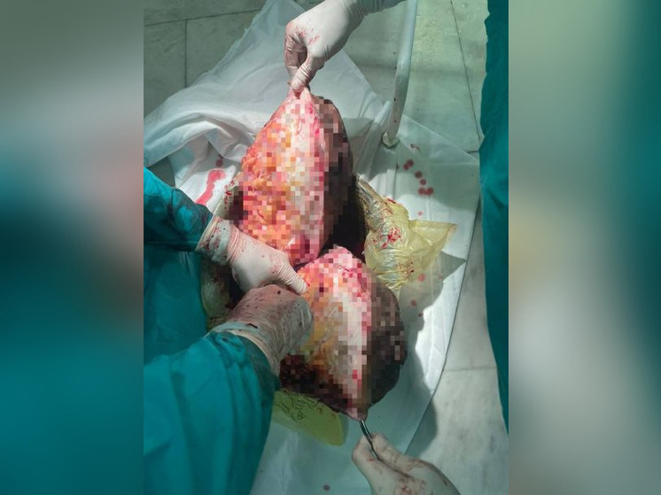 Уфимские хирурги удалили у мужчины опухоль весом 20 кг
