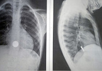 Рентген грудной полости неожиданно выявил в пищеводе семилетнего мальчика три 50-копеечные монеты.