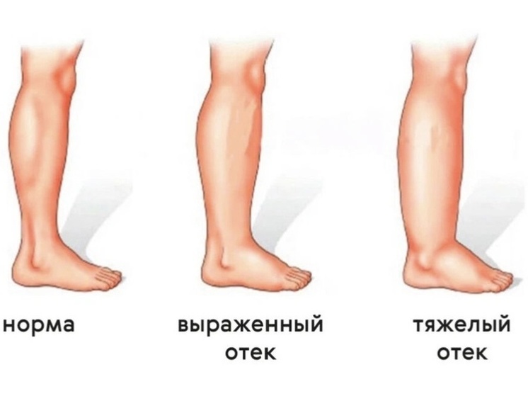 Лимфостаз Ног Картинки