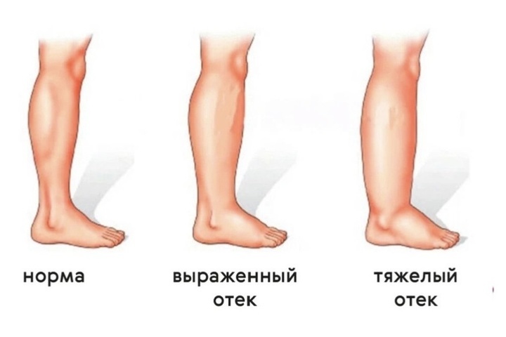 Отекают ноги как быстро снять отек