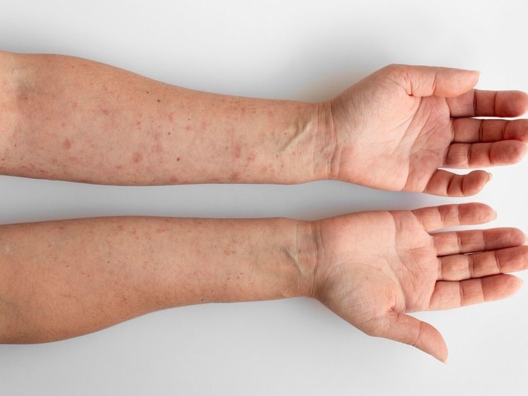 Стало известно, сколько людей и как заразились корью в районах Карелии