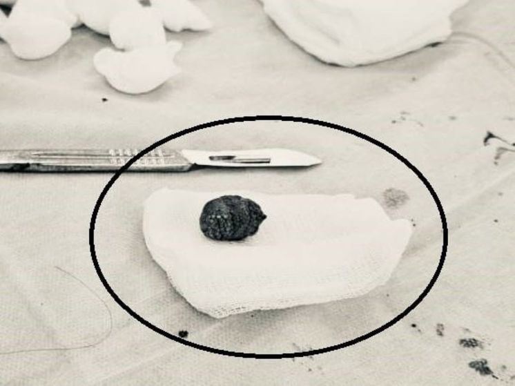 В Долгопрудном спасли пациента с камнем, выпавшим за пределы желчного