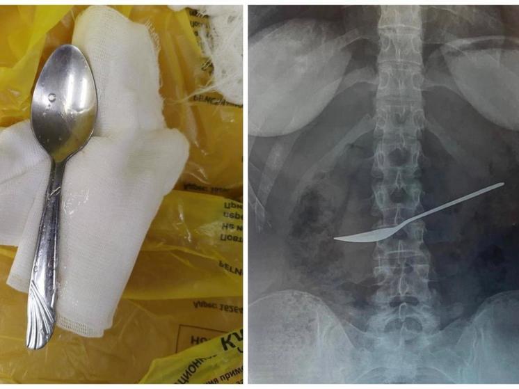 Вологодские врачи извлекли из желудка вологжанки металлическую ложку