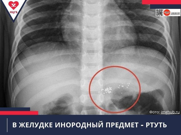 В Новом Уренгое малыш разгрыз градусник и проглотил ртуть
