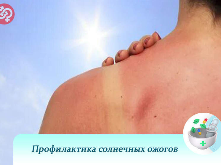 Пензенский врач рассказал, как избежать солнечных ожогов