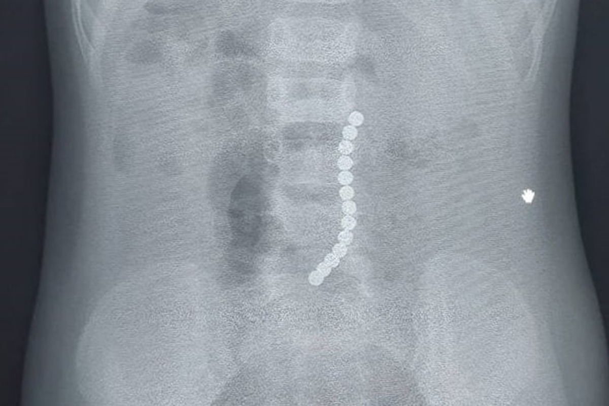 Двухлетняя девочка проглотила чертову дюжину магнитов - МК