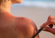 Специалисты посоветовали следить за реакцией кожи на солнечные лучи
