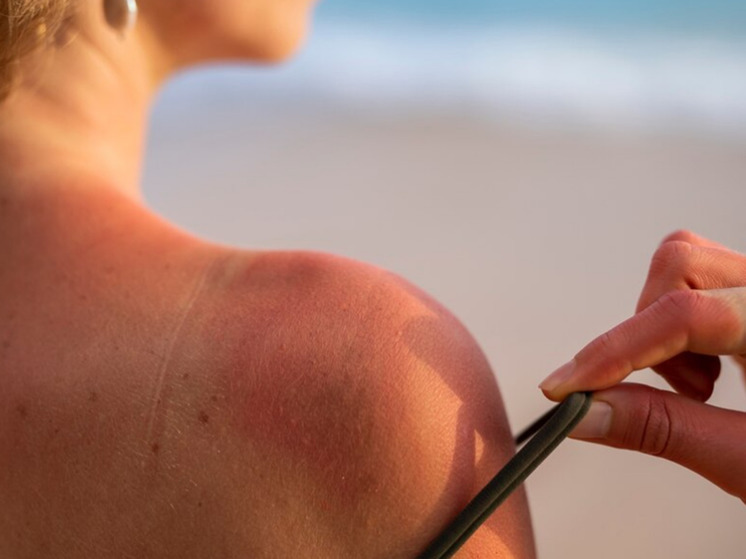 Специалисты посоветовали следить за реакцией кожи на солнечные лучи