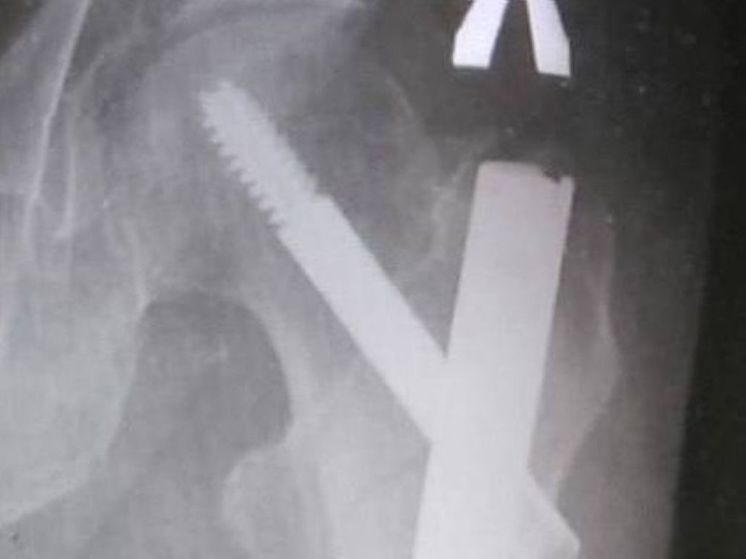 В Луховицах врачи спасли 91-летнего мужчину, упавшего в погреб