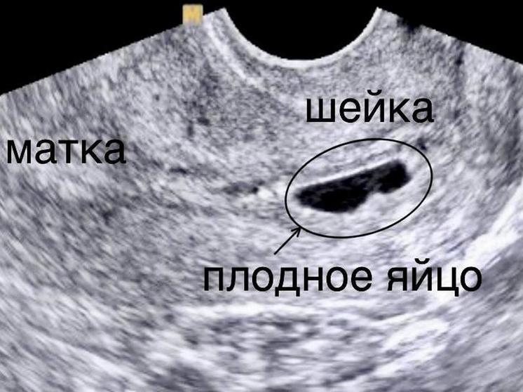 Врачи в Саратовской области столкнулись с редкой патологией пациентки
