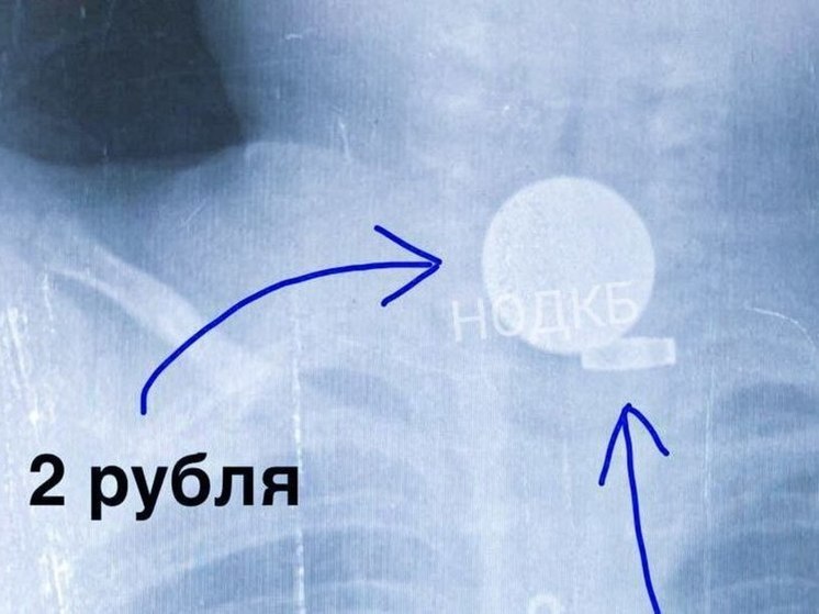 Врачи удалили монету из пищевода малыша в Нижнем Новгороде