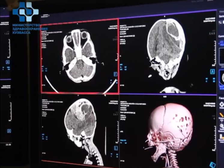 Врачи в Кемерове удалили смертоносное образование в голове младенца