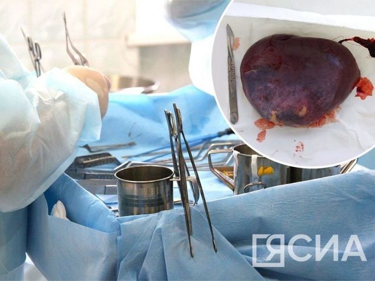 В Якутске прошла операция по удалению редкой кисты селезенки у 23-летней пациентки
