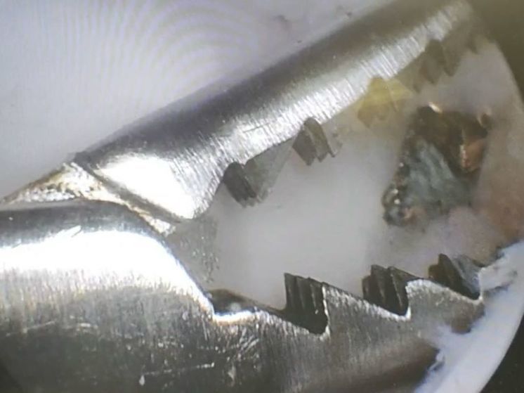 В Подмосковье спасли мужчину с металлической занозой в ноге