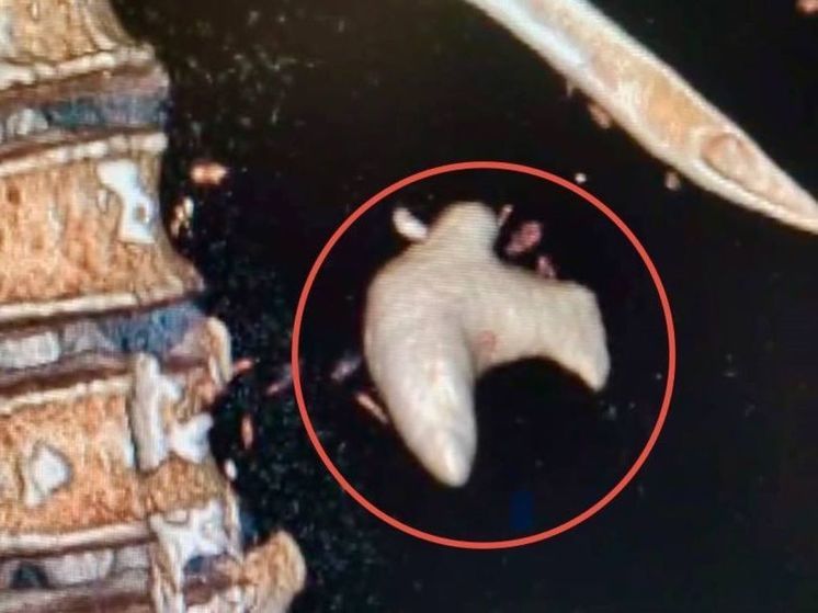 В Подмосковье мужчине удалили 5-сантиметрвый коралловидный камень в почке