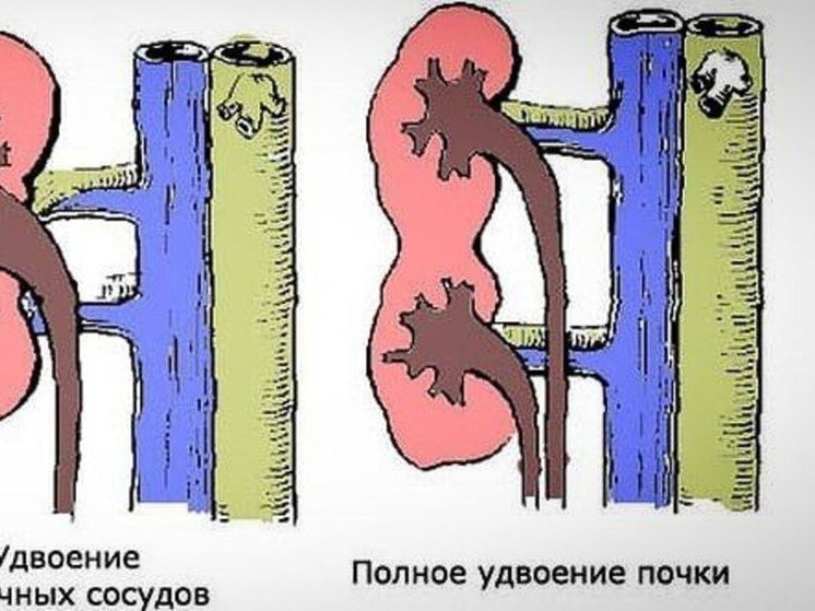 У нижегородца во время операции обнаружили две пары почек