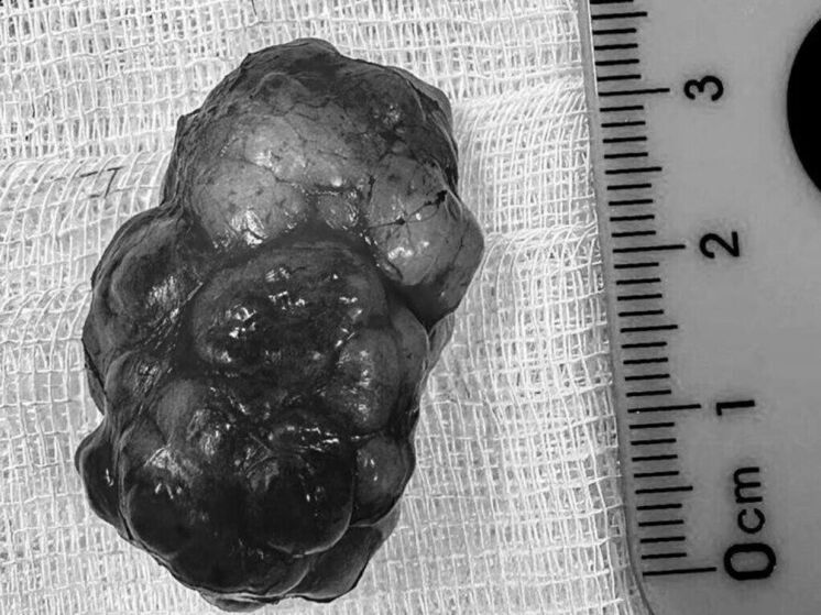 В Центре им. Рошаля девушке выполнили сложную операцию по удалению опухоли на лице