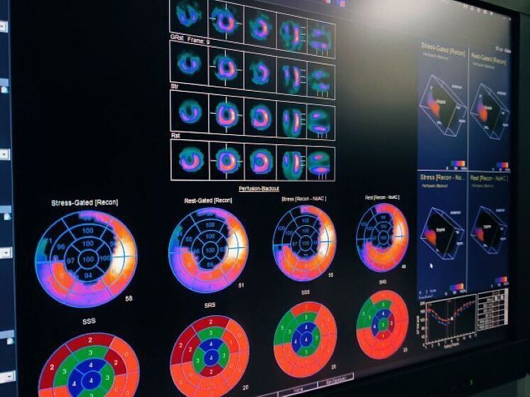 Сцинтиграфия сердца стала доступна всем жителям Кировской области