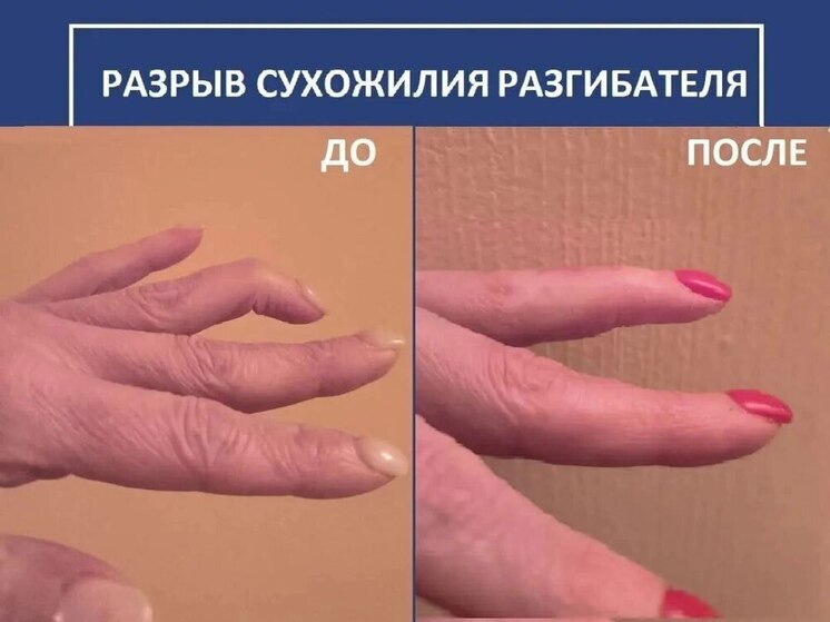 Томские врачи вылечили палец женщине после травмы от тяжелой сумки