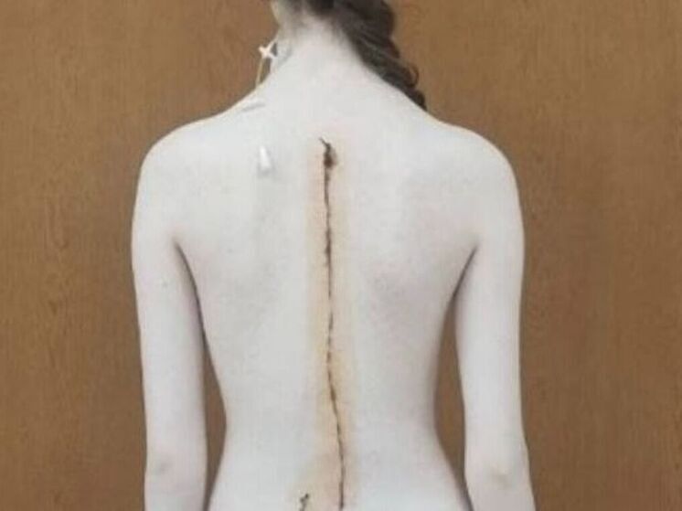 В центре им. Рошаля девочку избавили от сколиоза IV степени