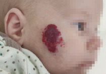 В Новгородской области родилась девочка с небольшими сосудистыми пятнами на лице