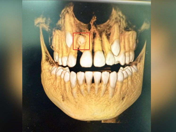 В Уфе врачи удалили 13-летнему мальчику сверхкомплектный зуб