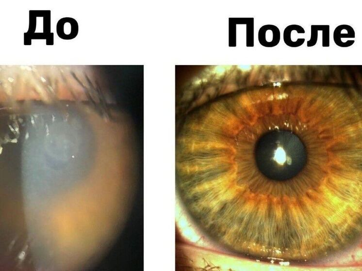 В Подмосковье спасли зрение подростку, который три месяца не снимал линзы