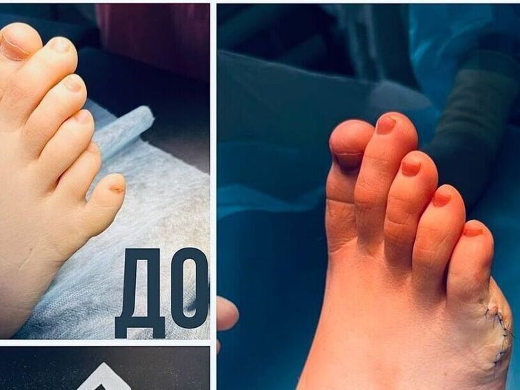 Подростка с шестью пальцами на стопе прооперировали в Подмосковье