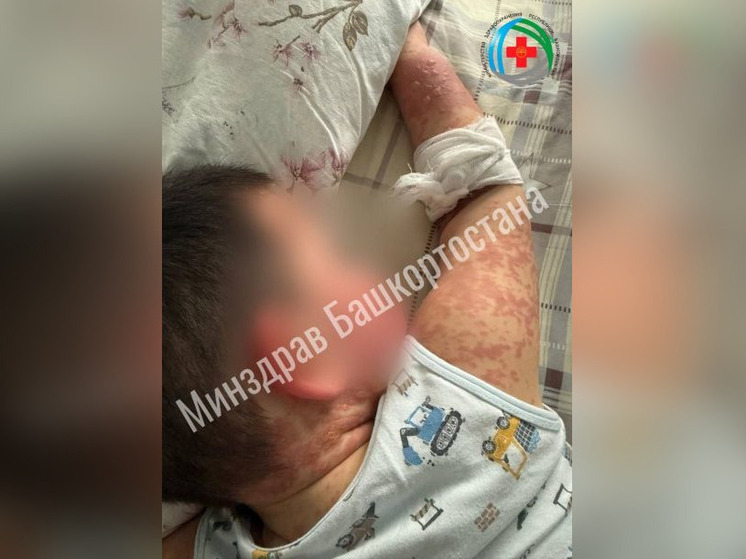 Уфимские врачи спасли жизнь ребенку с синдромом «ошпаренной кожи»