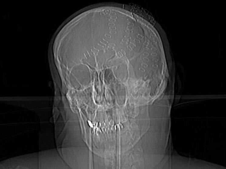 Нейрохирурги Владивостока спасли мужчину с раздробленным черепом после удара топором